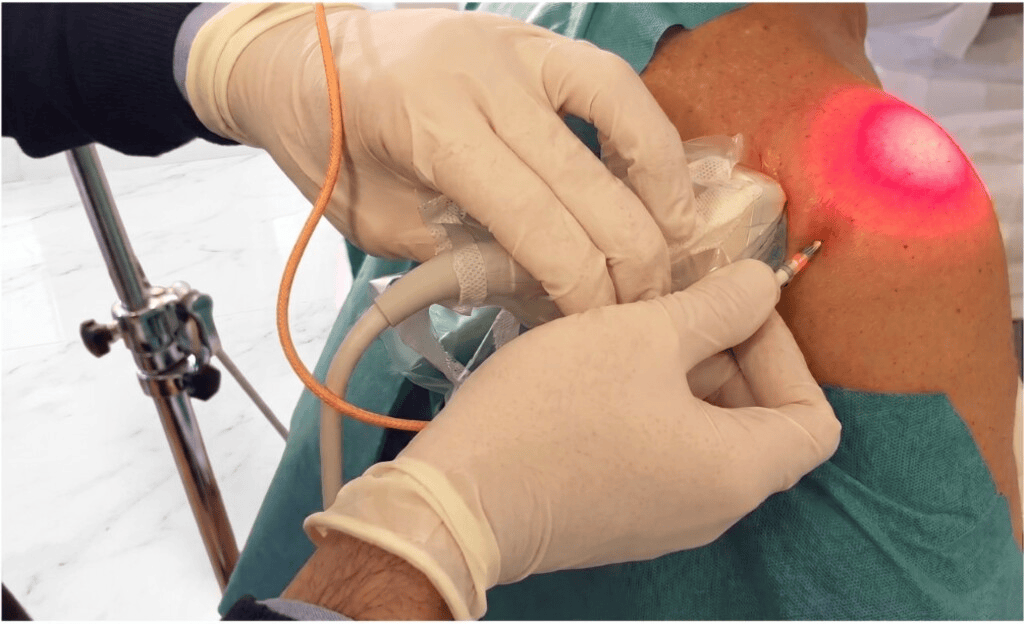 Laserterapia intra-articolare