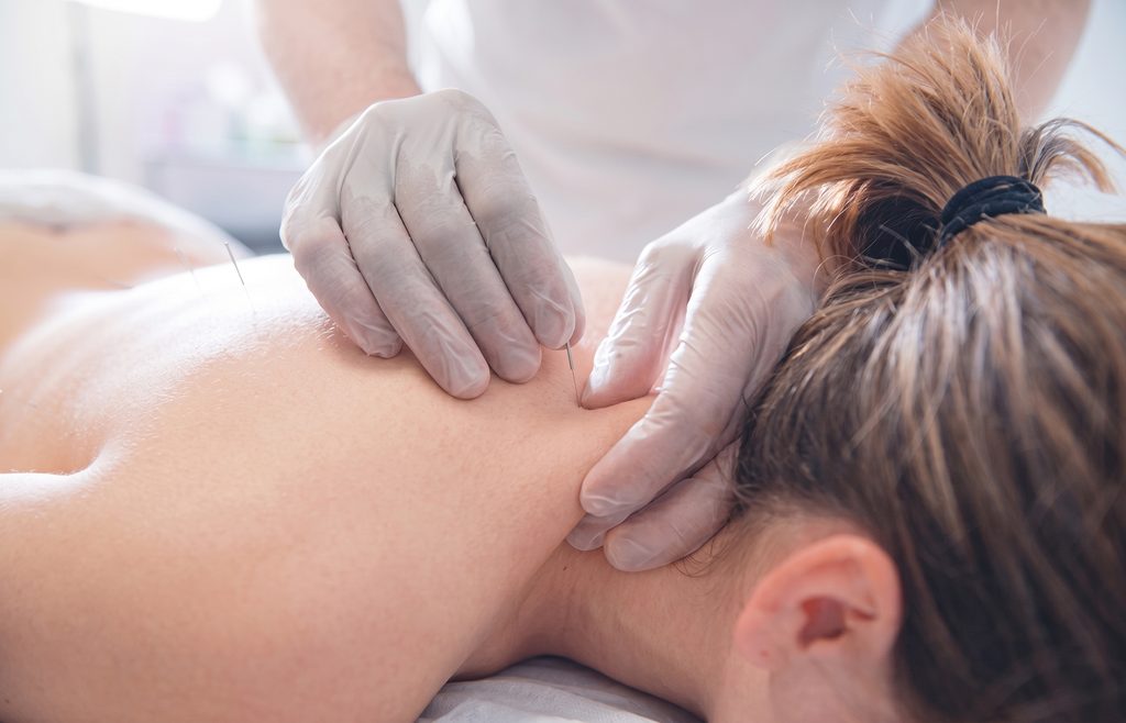 Inserimento di un ago di agopuntura tra collo e spalla