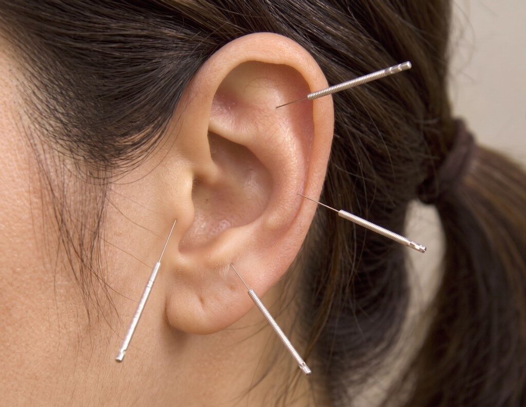 Agopuntura auricolare sul padiglione dell'orecchio
