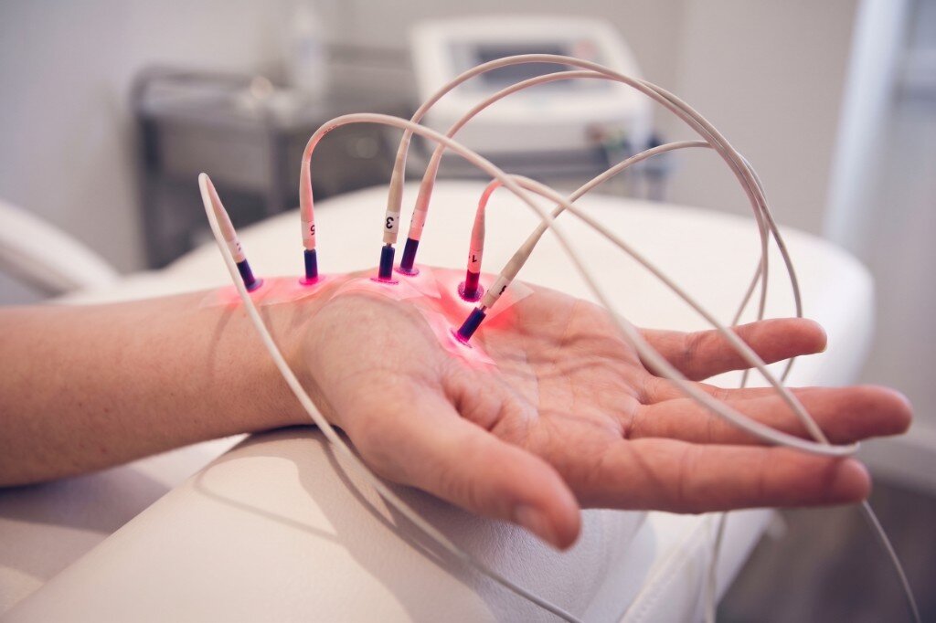 Trattamento laser della mano: la foto non mostra un catetere interstiziale